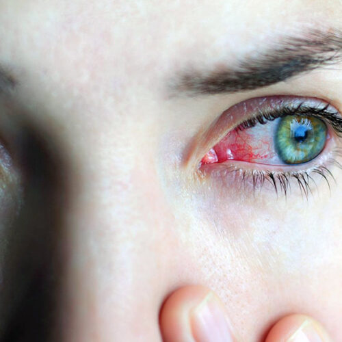Common Eye Disorders and Diseases!